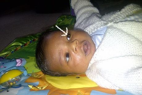 6 Tumor Menempel di Mata Jernih Bayi Romero