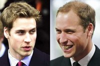Kebotakan berpola yang dialami oleh Putra Mahkota Kerajaan Inggris, Pangeran William jadi perbincangan seru gara-gara sering tertangkap kamera saat upacara pernikahannya dengan Kate Middleton. Dengan usia yang baru 30 tahun, ia dinilai masih terlalu muda untuk berkepala botak. (Foto: NY Dailynews)