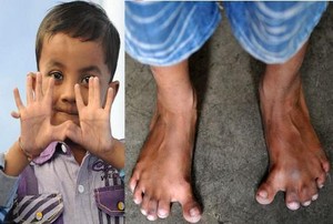 Punya 2 Kelainan Genetik Langka, Anak Ini Punya 25 Jari