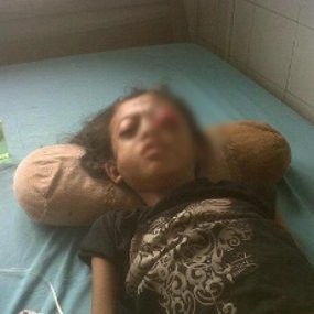 Pasien Mata Keluar Seperti Rahel Jarang Terjadi