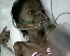 Perut Bocah Penderita Kanker Ganas yang Dirawat di RS Carolus Membesar