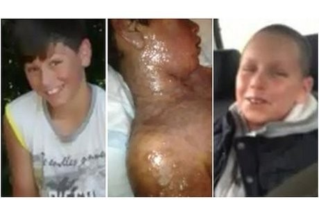Kulit Bocah Ini Hampir Mengelupas Gara-gara Obat Penurun Demam
