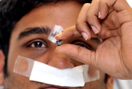 Tertembak di Dahi, Tapi Peluru Keluar dari Hidung