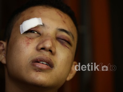 Dibogem Diego Michiels, Mef Cacat Sementara