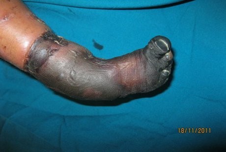 Gara-gara Dukun Patah Tulang, Kaki Bocah Jadi Mirip Mumi