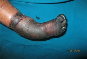 Gara-gara Dukun Patah Tulang, Kaki Bocah Jadi Mirip Mumi