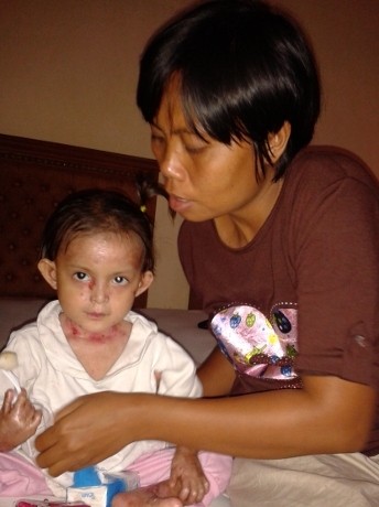 Mantan Juara Dunia Perahu Naga Berjuang Melawan Penyakit Kulit Anaknya