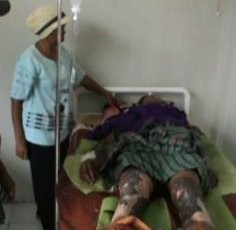 Tujuh Korban Kebakaran Sumur Minyak Ilegal Menderita Luka Bakar Parah 