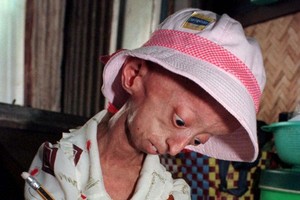 Ini 8 Kondisi Medis Paling Aneh