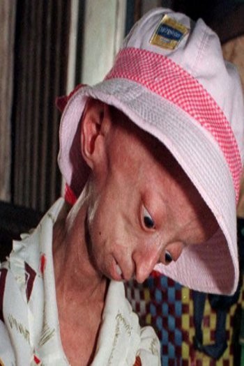 Ini 8 Kondisi Medis Paling Aneh