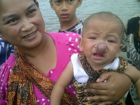 Dibantu SBY, Bocah Penderita Tumor Hidung Kini Diobati di RSPAD