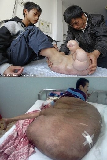 Orang-orang Ini Hidup dengan Kaki Raksasa karena Diserang Penyakit Aneh