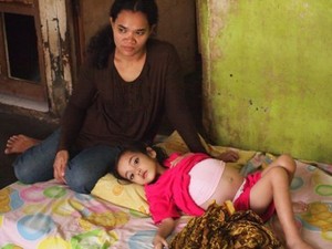 Fajar, Bocah Penderita Tumor Hati di Cilacap Butuh Bantuan