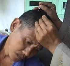 Terapi Tusuk Jarum Cara Tradisional Penyembuhan Pecandu Narkoba