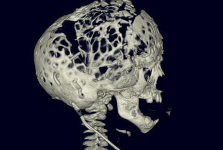 Bocah 2 Tahun Ini Lahir dengan Tengkorak Bolong-bolong Seperti Keju