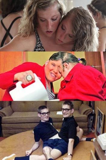 Inilah Kembar Siam Paling Terkenal di Dunia