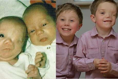 Kembar Tapi Tak Sama, Satu Bayi Lahir dengan Wajah Separuh