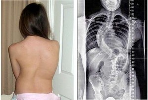 Gadis dengan Skoliosis Terburuk, Punggungnya Bisa Jadi Sirip Hiu