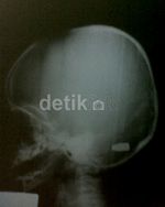Terkena Peluru Nyasar, Bayi Fatir Meninggal