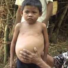 Perut Terus Membesar, Bocah 9 Tahun di Pasuruan Tak Bisa Berobat