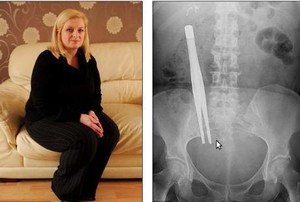 Ya Ampun, Tang 18 Cm Bersemayam di Tubuh Perempuan Ini