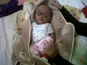 Derita Bayi 6 Bulan Asal Bandung yang Alami Kebocoran Cairan Otak