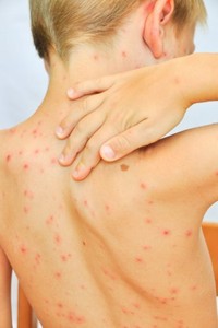 5 Keluhan yang Menandakan Tubuh Punya Alergi