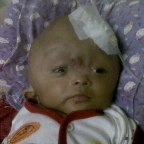 Bayi Penderita Kebocoran Otak Sudah Dioperasi Pasang Selang