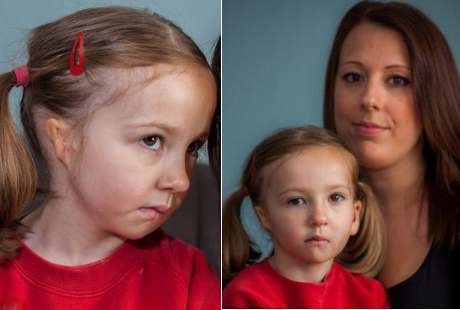 Gadis Malang yang Terlahir dengan Satu Buah Telinga