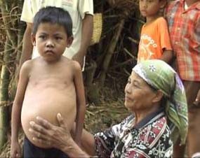 Imam Bukhori, Bocah Penderita Sirosis Hati Belum Ditangani