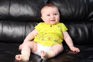 Kulit Rapuh, Bayi 5 Bulan Ini Diberi Morfin Setiap akan Mandi