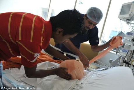 Kepala Bayi Hydrochepalus Ini Mendekati Normal Usai Operasi Tengkorak