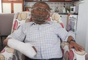 Ingin Berhenti Merokok, Pria Ini Pakai Kandang Burung di Wajahnya