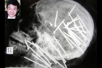 Foto-foto Sinar-X Paling Seram, Paku di Kepala Hingga Belut Masuk Anus