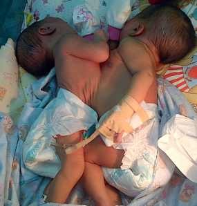 Bayi Kembar Siam Kediri Dirujuk ke Surabaya