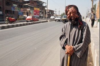 Penyakit Langka Bikin Wajah Pria Ini Meleleh
