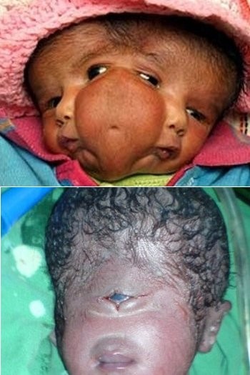 6 Bayi yang Terlahir dengan Kondisi Langka, Punya 2 Wajah Hingga 1 Mata