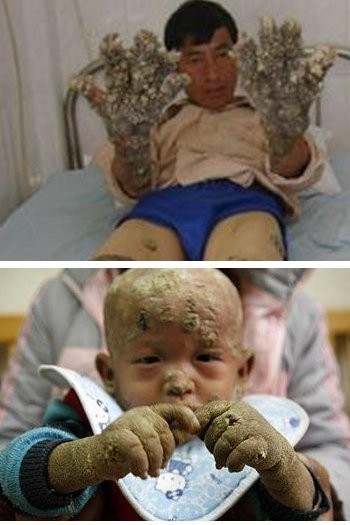 Benda Aneh yang Tumbuh di Tubuh Manusia, Terumbu Karang Hingga Pohon Cemara