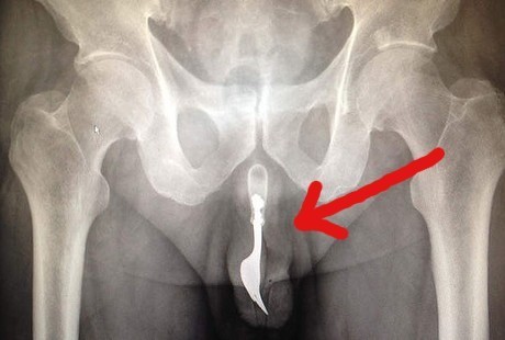 Mr P Kemasukan Garpu, Pria di Canberra Dilarikan ke UGD