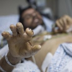 Ledakan Bom Kimia Napalm Guncang Sekolah di Suriah, 10 Siswa Tewas