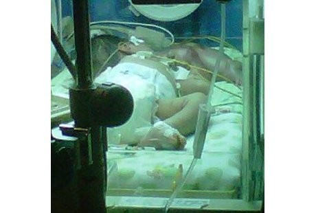 Kasihan, Bayi Kembar Asal Bandung Ini Keluar dari Mulut Bayi Lainnya