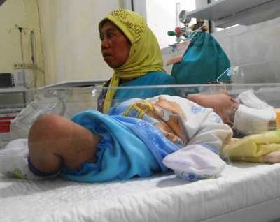 Bayi Tanpa Tempurung Kepala Dirawat Intensif di RSU Situbondo