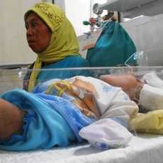 Bayi Tanpa Tempurung Kepala Dirawat Intensif di RSU Situbondo
