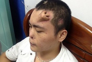 Hidung Rusak karena Infeksi, Pria Ini Punya Hidung Baru di Dahi