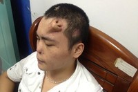 Xiaolian (22) mengalami trauma hidung setelah kecelakaan lalu lintas pada bulan Agustus 2012. (Foto: Reuters)