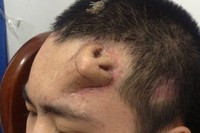 Hidung baru tumbuh dengan menempatkan expander jaringan kulit ke dahi Xiaolian, dipotong menjadi bentuk hidung dan menanam tulang rawan yang diambil dari tulang rusuknya. (Foto: Reuters)