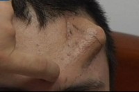 Para ahli bedah mengatakan bahwa hidung baru dalam kondisi yang baik dan operasi transplantasi bisa dilakukan segera. (Foto: Reuters)
