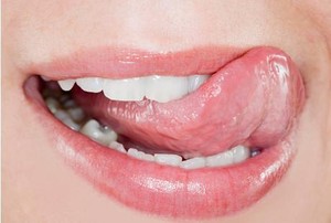 Lidah Tak Sengaja Tergigit Saat Makan? Ini Cara Mengobatinya