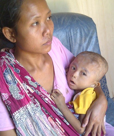 Kasihan...Batita Ini Hanya Punya Berat Badan 7,6 Kg