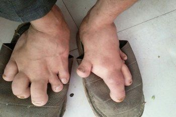  Ketika Pria Berkaki Raksasa Mendapat Sepatu yang Pas